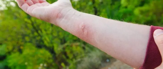 Piqûre de frelon asiatique avec gonflement localisé sur le bras